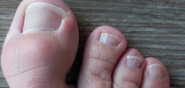 CrippledToe